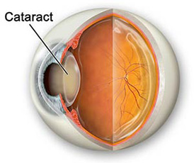 Cataract